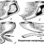 Kishechnaja-neprohodimost-vidy