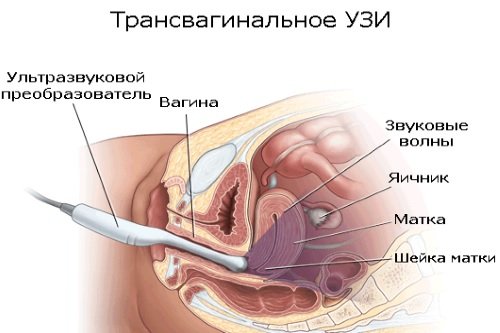 Transvaginalnoe-UZI