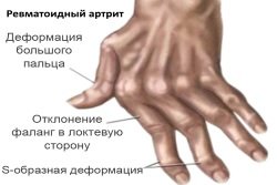Revmatoidnyj-artrit