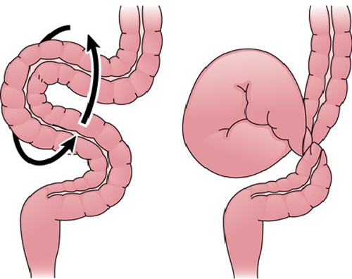 Тотальный некроз тонкого кишечника синдром короткой кишки thumbnail