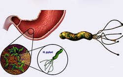 Бактерии Helicobacter pylori - причина заболевания