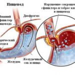 Refljuks-zheludka-iz-za-bulimi