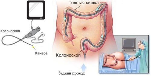 Колоноптоз кишечника: определение, симптомы, лечение и прогноз