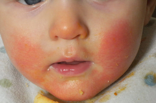 Пищевая аллергия у детей: симптомы, лечение ребенка, диета, причины. Как выглядит и как проявляется?