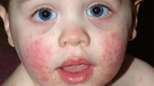Пищевая аллергия у детей: симптомы и лечение (диета, препараты)