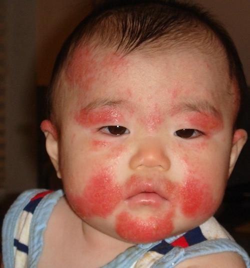 Пищевая аллергия у детей: симптомы и лечение (диета, препараты)