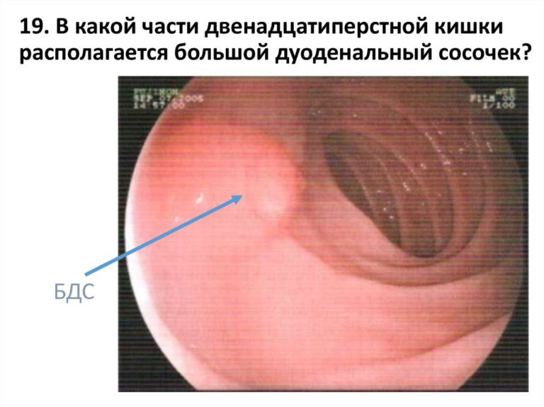 большой дуоденальный сосочек