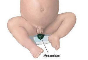 meconium