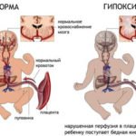 Гипоксия плода