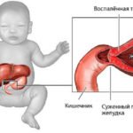 Пилоростеноз младенца