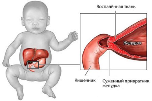 Пилоростеноз младенца