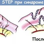 Операция при синдроме короткой кишки