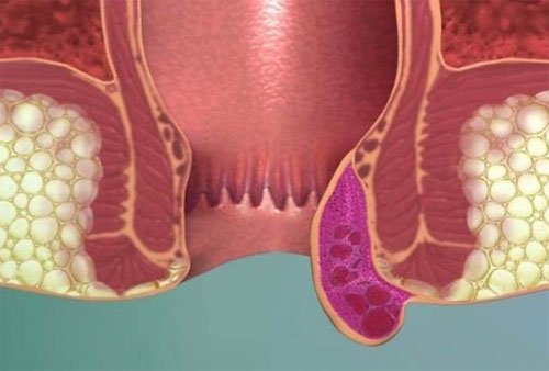 Тромбоз геморроидального узла