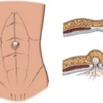 Грыжа передней брюшной стенки живота