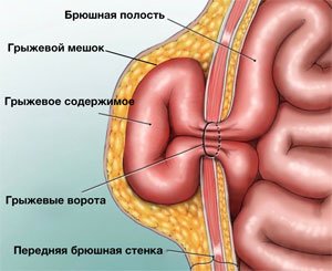 Грыжа брюшной стенки живота