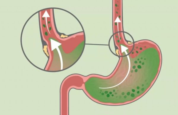 Как желчь попадает в желудок: причины