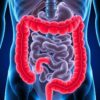 Colitis ulcerosa: Síntomas, causas y abordajes terapéuticos que deberías conocer