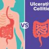 Crohn’s Disease vs. Ulcerative Colitis: Understanding the Key Differences and Similarities