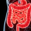 Entendiendo la diverticulitis: Inflamación en el colon
