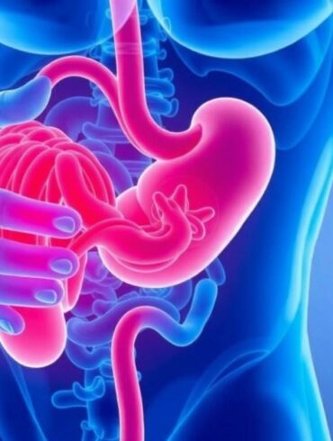 Diverticulitis: Symptoms, Causes, and Treatment Explained