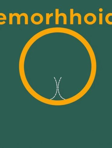 Hemorrhoids: Prevention and Treatment – A Complete Guide to Comfort and Relief