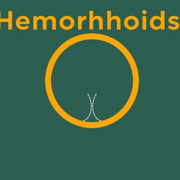 Hemorrhoids: Prevention and Treatment – A Complete Guide to Comfort and Relief