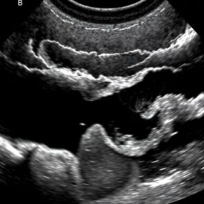 УЗИ желчного пузыря и поджелудочной: что проверяют, как подготовиться и что значат результаты