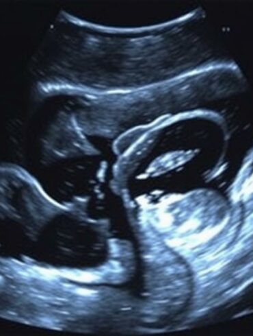 УЗИ брюшной полости: что это, зачем и как к нему подготовиться